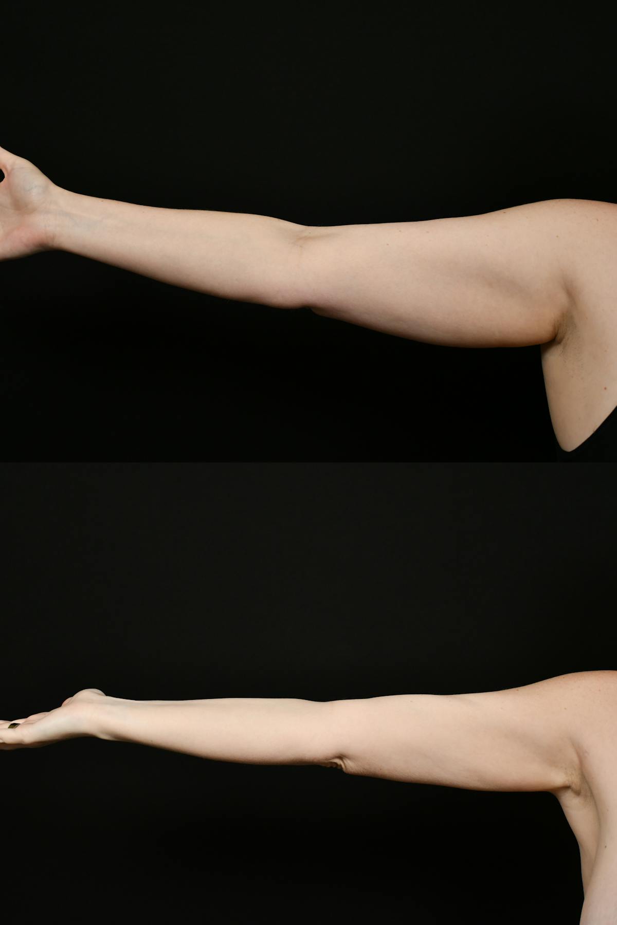 Liposuction / BodyTite Before & After Gallery - Patient 922880 - Image 4