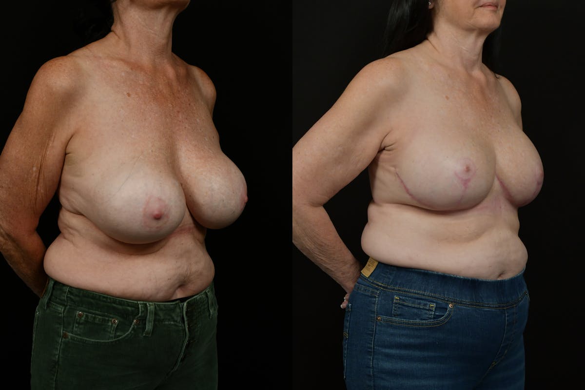 Breast Revision Before & After Gallery - Patient 287046 - Image 2