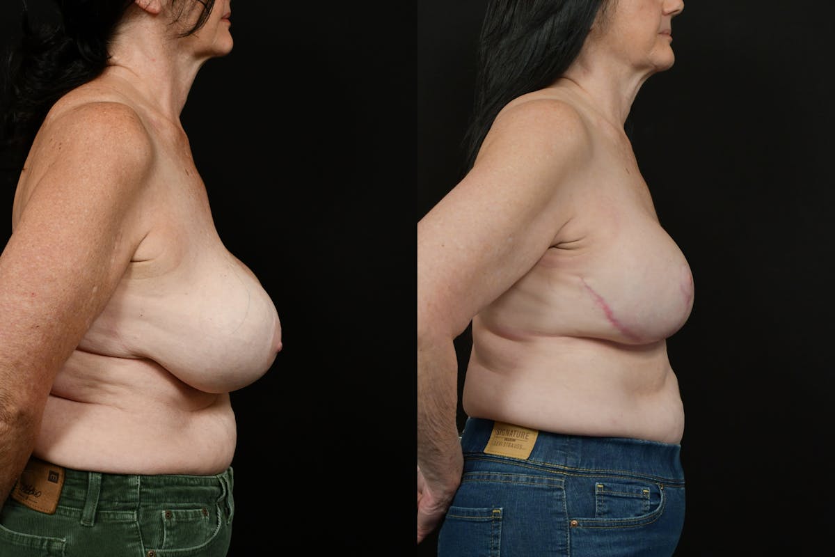 Breast Revision Before & After Gallery - Patient 287046 - Image 3