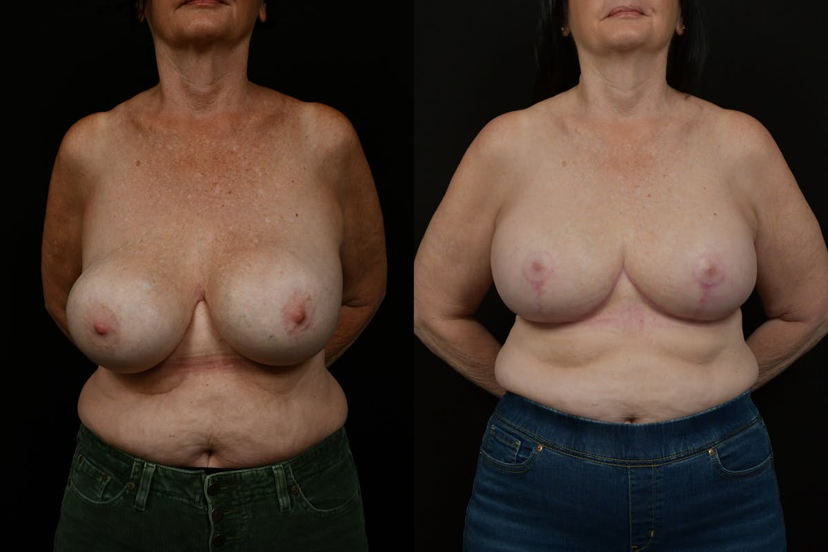 Breast Revision Before & After Gallery - Patient 287046 - Image 1