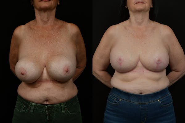 Breast Revision Before & After Gallery - Patient 287046 - Image 1