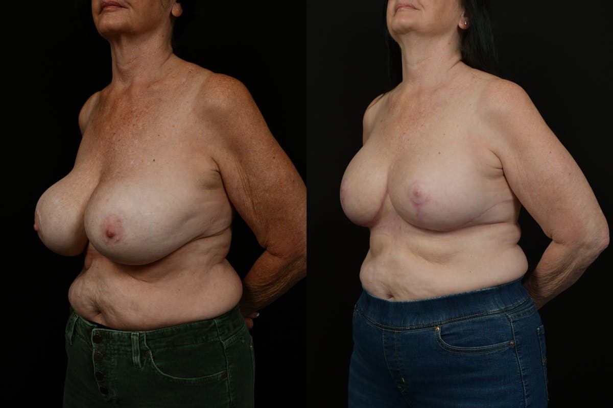 Breast Revision Before & After Gallery - Patient 287046 - Image 4
