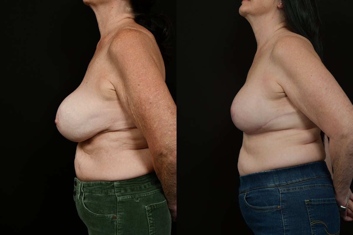 Breast Revision Before & After Gallery - Patient 287046 - Image 5