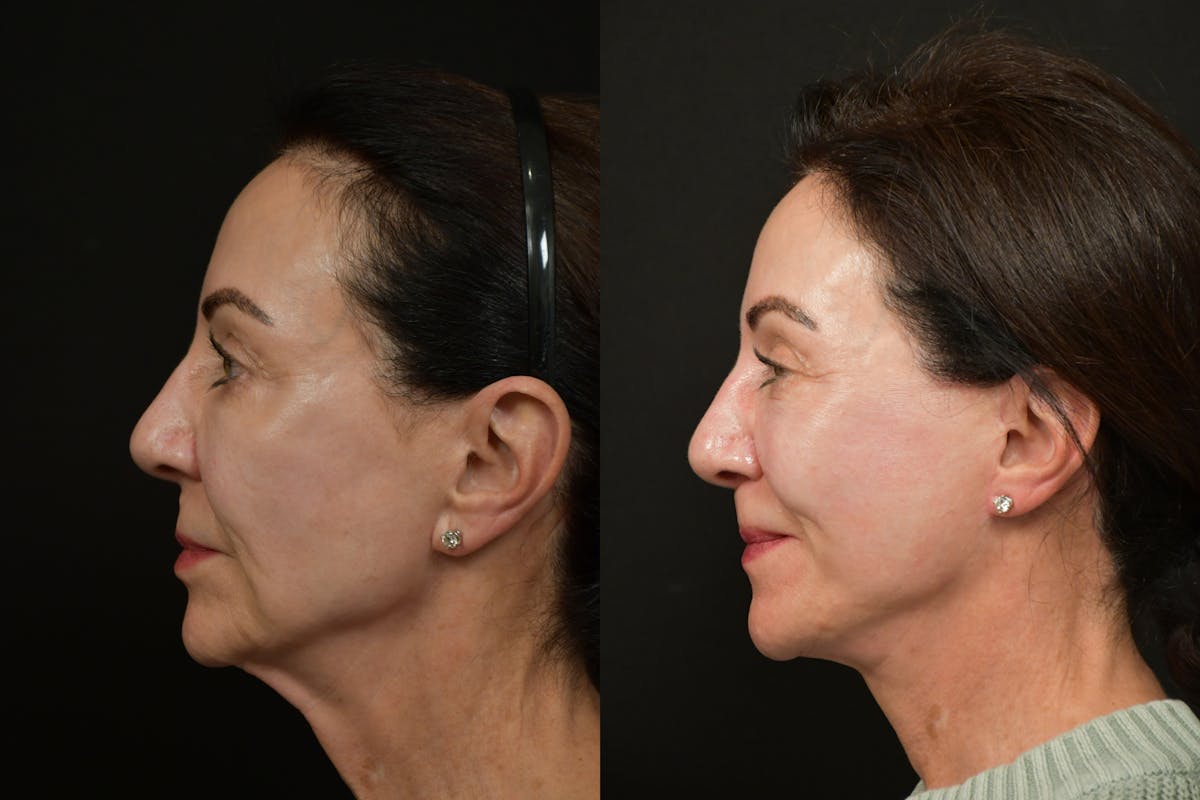 Neck Lift Before & After Gallery - Patient 886713 - Image 2