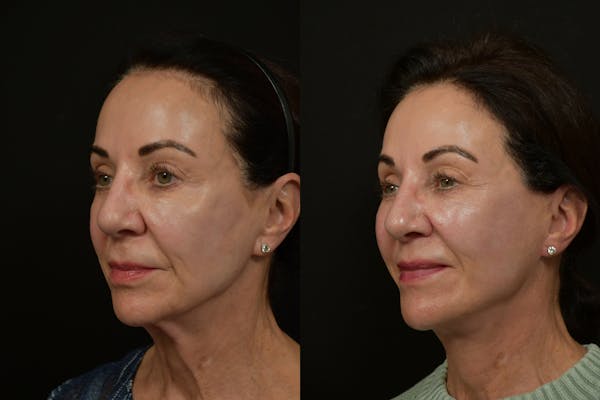 Neck Lift Before & After Gallery - Patient 886713 - Image 1