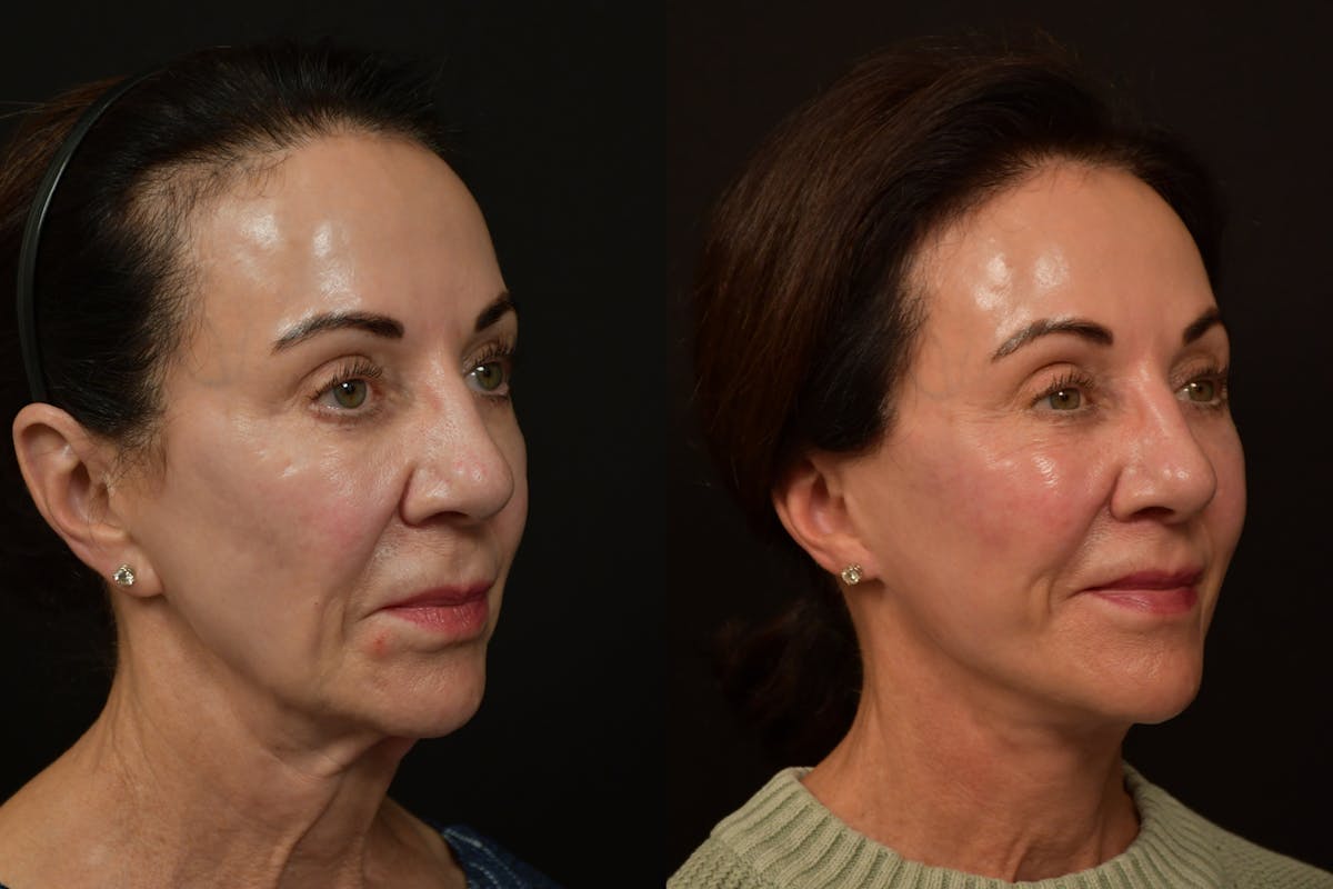 Neck Lift Before & After Gallery - Patient 886713 - Image 3