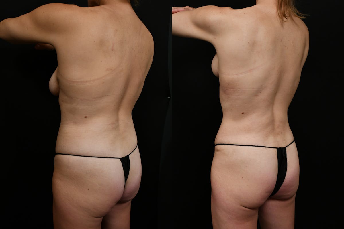 Tummy Tuck Before & After Gallery - Patient 262346 - Image 4