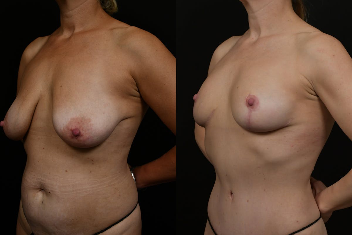 Breast Augmentation Before & After Gallery - Patient 398963 - Image 4