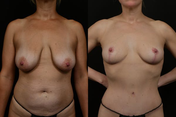 Breast Augmentation Before & After Gallery - Patient 398963 - Image 1