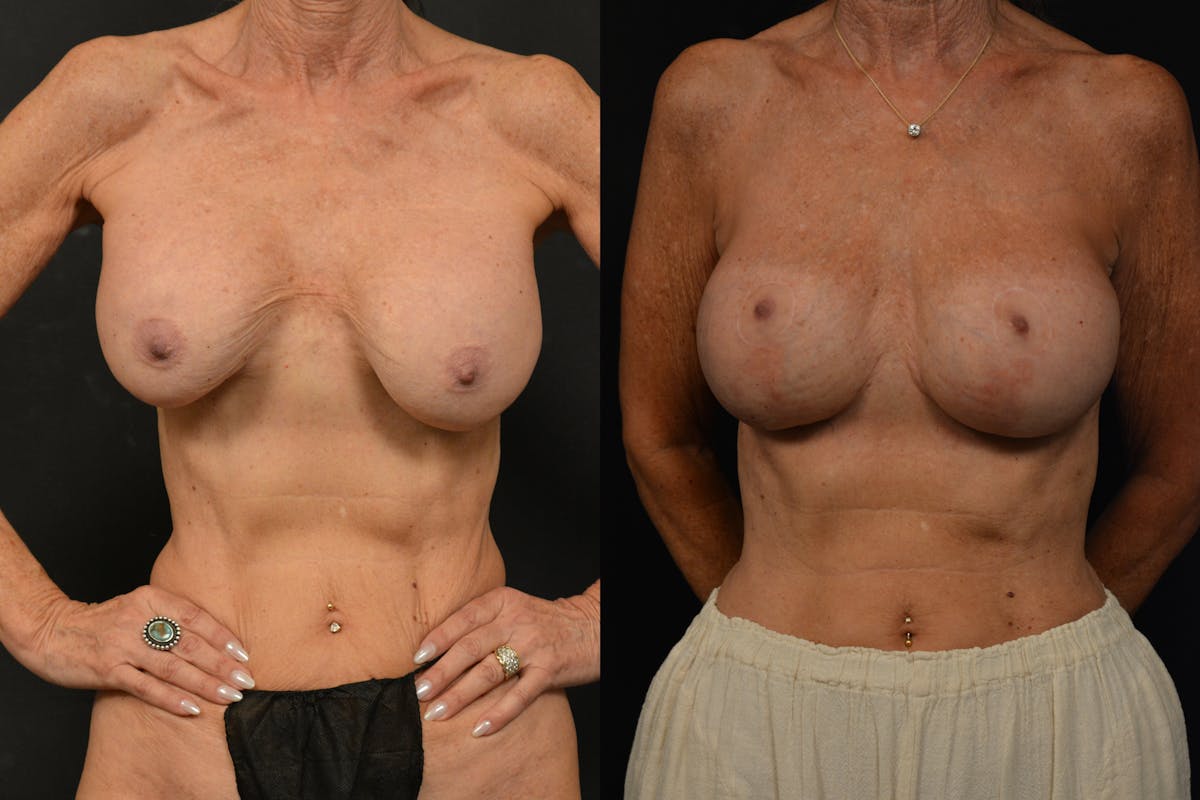 Breast Revision Before & After Gallery - Patient 297840 - Image 1
