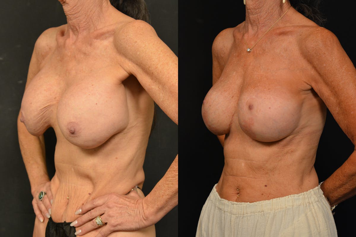 Breast Revision Before & After Gallery - Patient 297840 - Image 4