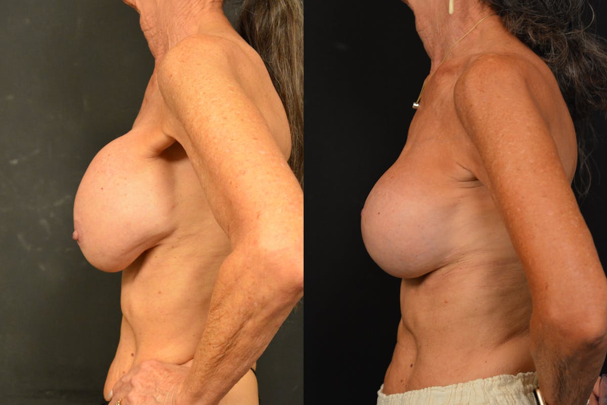 Breast Revision Before & After Gallery - Patient 297840 - Image 5