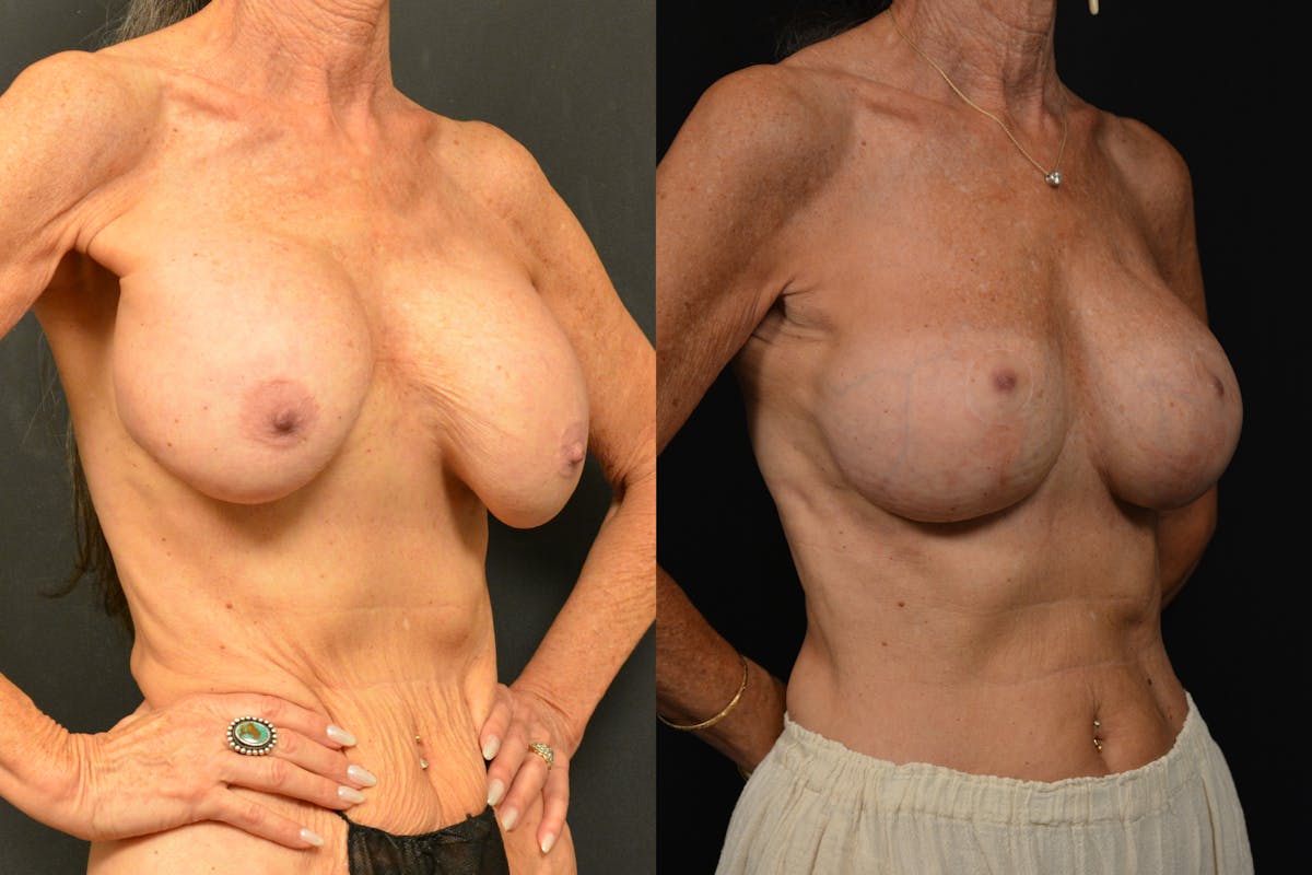 Breast Revision Before & After Gallery - Patient 297840 - Image 2
