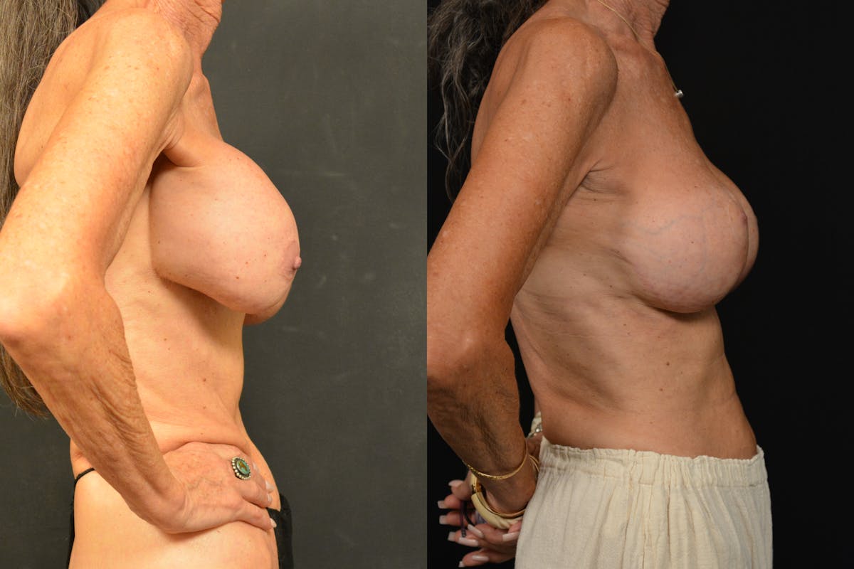 Breast Revision Before & After Gallery - Patient 297840 - Image 3