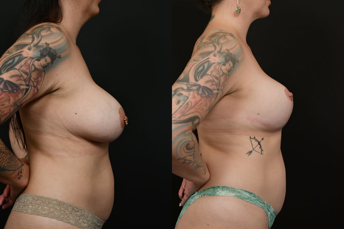 Breast Revision Before & After Gallery - Patient 162553 - Image 5