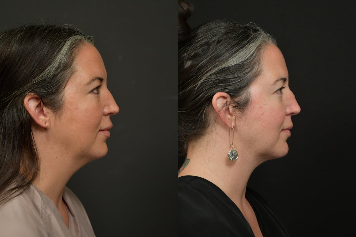 Chin (Submental) Liposuction Before & After Gallery - Patient 401598 - Image 5
