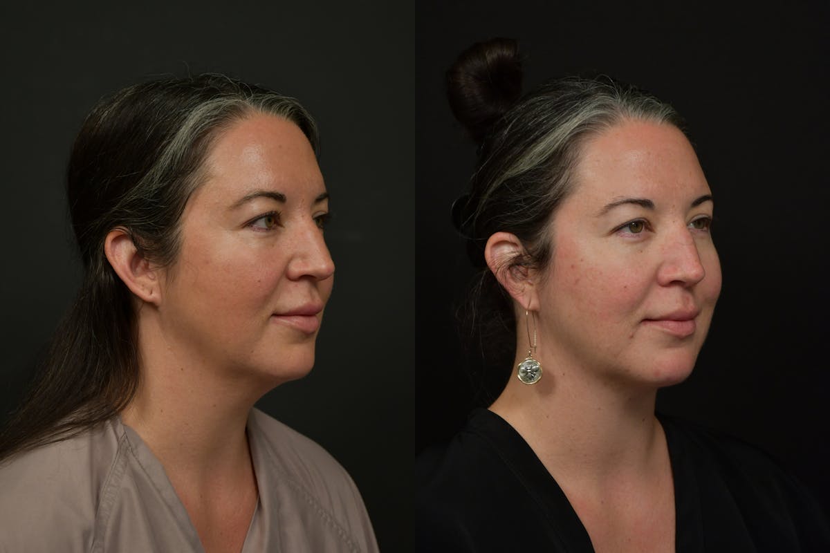 Chin (Submental) Liposuction Before & After Gallery - Patient 401598 - Image 4