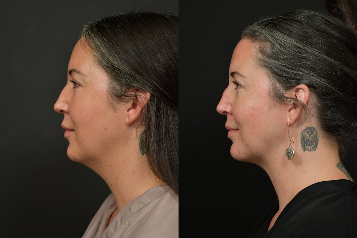 Chin (Submental) Liposuction Before & After Gallery - Patient 401598 - Image 2