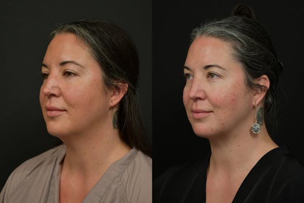 Chin (Submental) Liposuction Before & After Gallery - Patient 401598 - Image 1