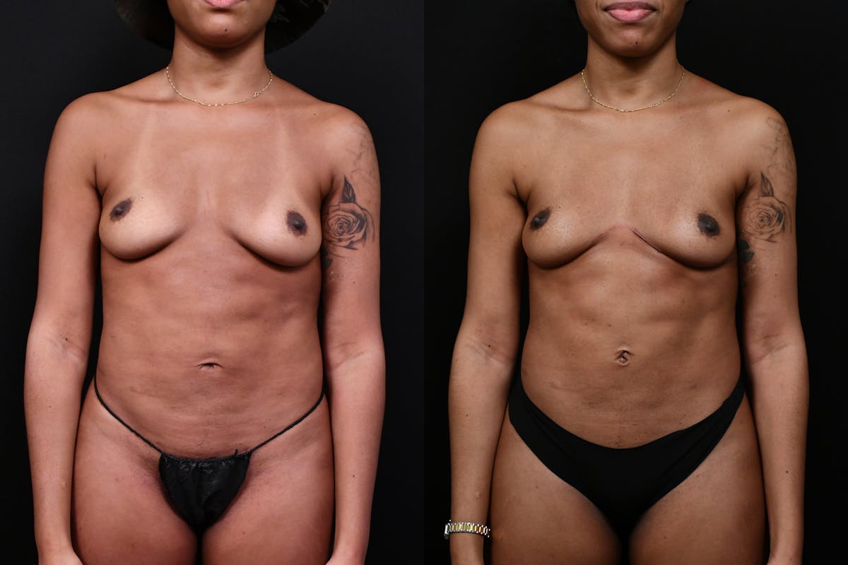 Liposuction / BodyTite Before & After Gallery - Patient 113114 - Image 9