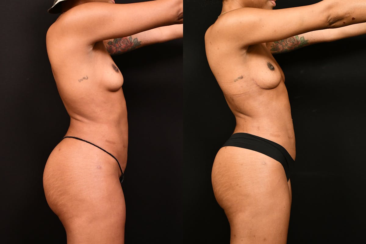 Liposuction / BodyTite Before & After Gallery - Patient 113114 - Image 3