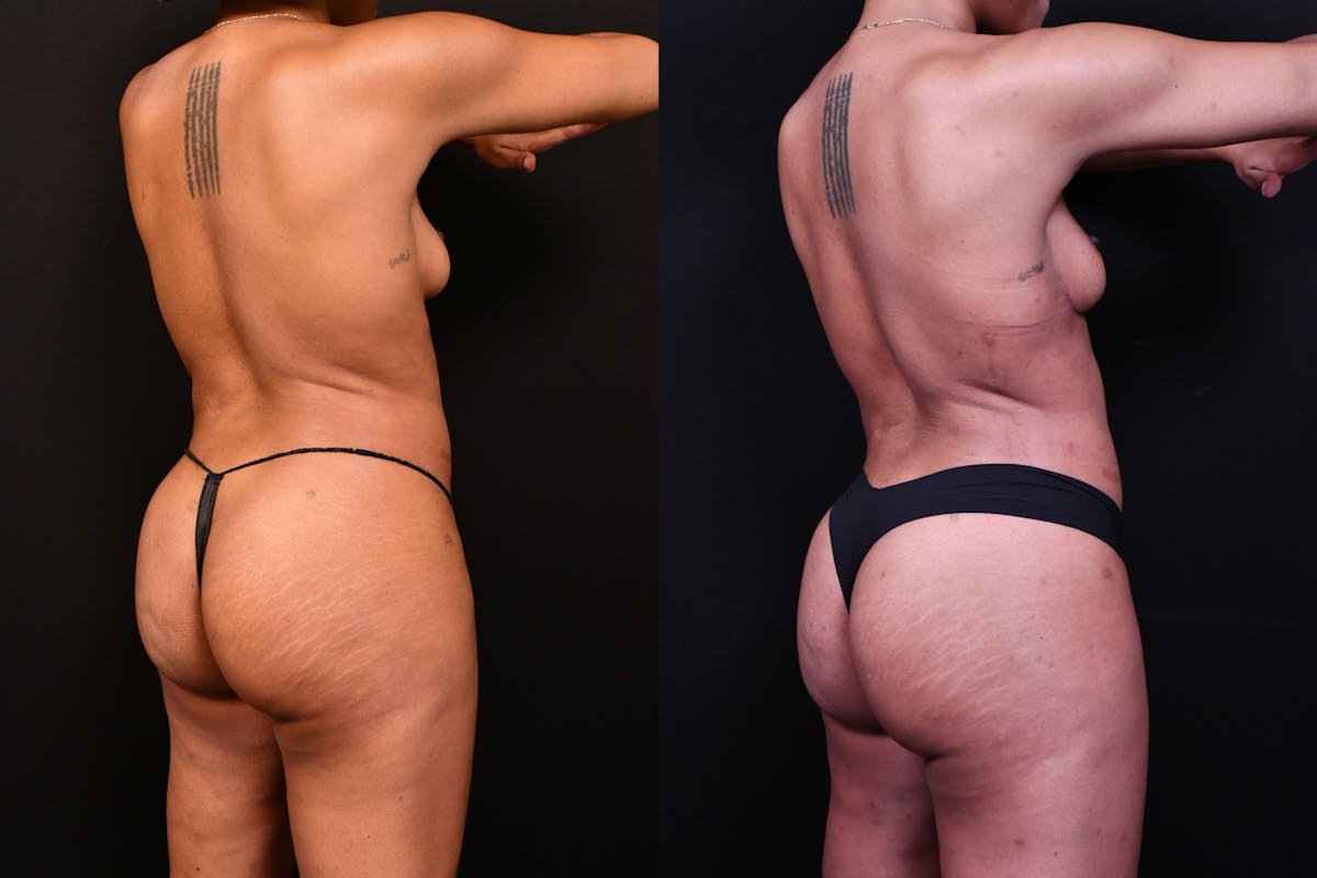 Liposuction / BodyTite Before & After Gallery - Patient 113114 - Image 4