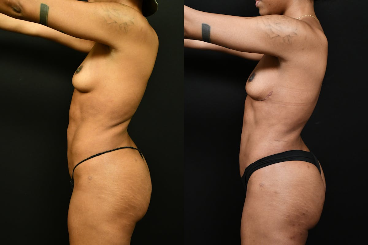 Liposuction / BodyTite Before & After Gallery - Patient 113114 - Image 7