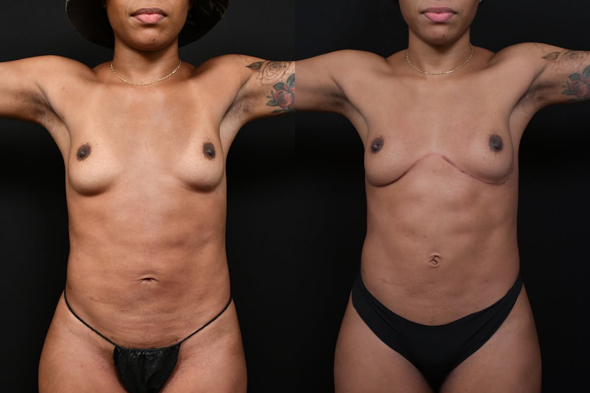 Liposuction / BodyTite Before & After Gallery - Patient 113114 - Image 1
