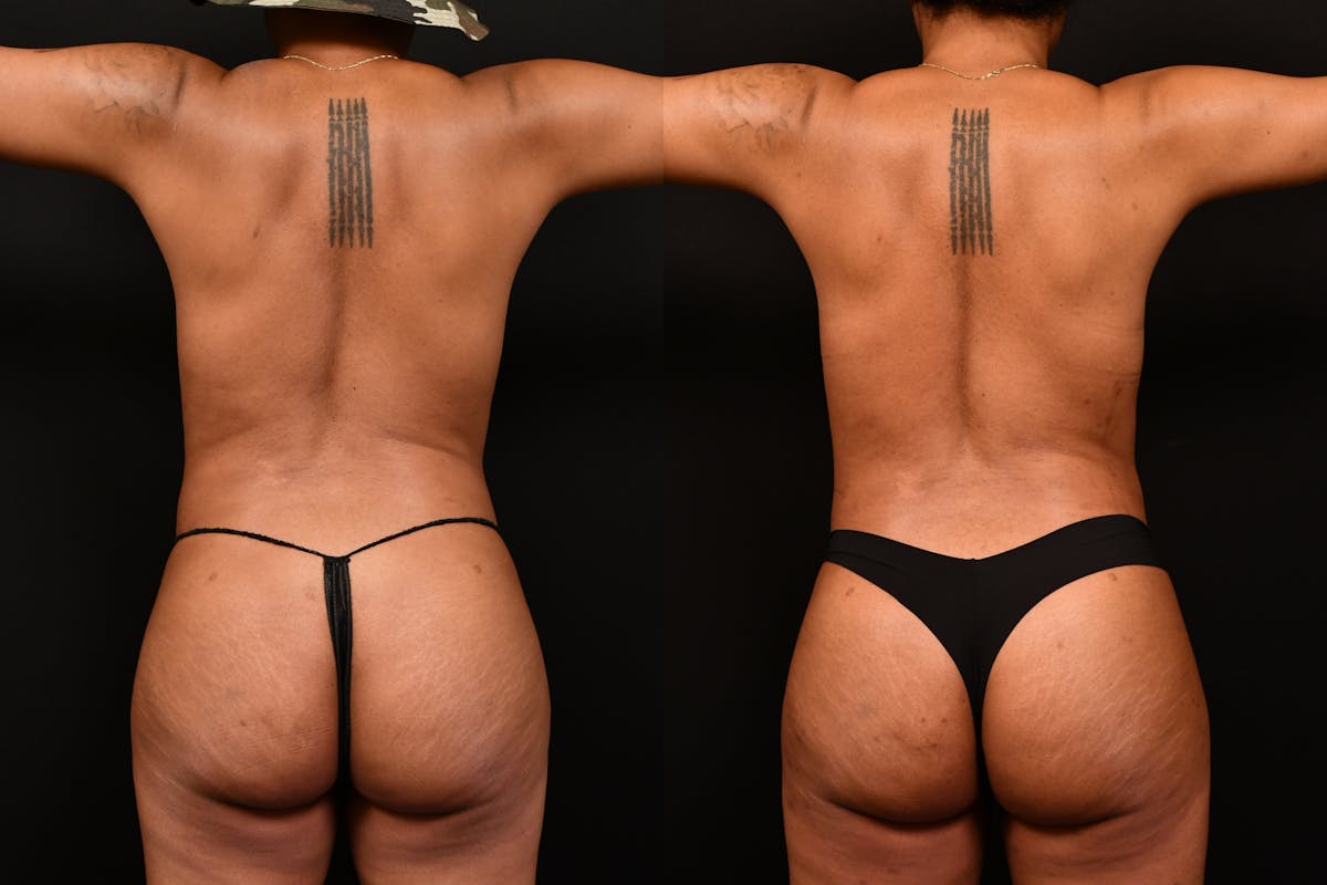 Liposuction / BodyTite Before & After Gallery - Patient 113114 - Image 5