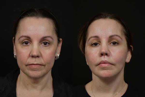 Lip Lift Before & After Gallery - Patient 475169 - Image 1