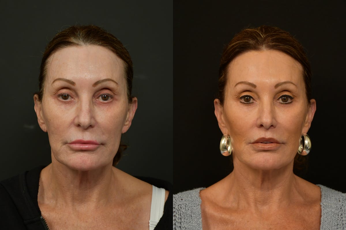 Lip Lift Before & After Gallery - Patient 212644 - Image 1