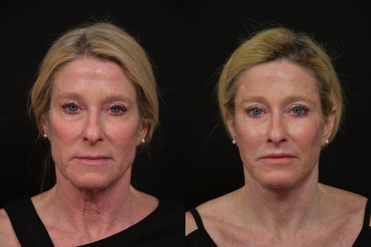 Lip Lift Before & After Gallery - Patient 170755 - Image 1