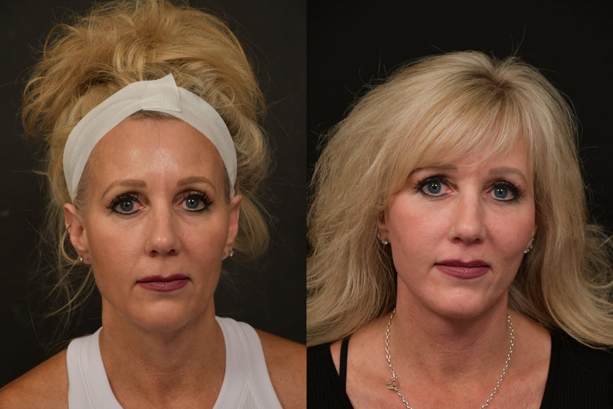 Changes Deep Plane Face Lift  Before & After Gallery - Patient 402220 - Image 2