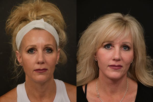 Lip Lift Before & After Gallery - Patient 292934 - Image 1