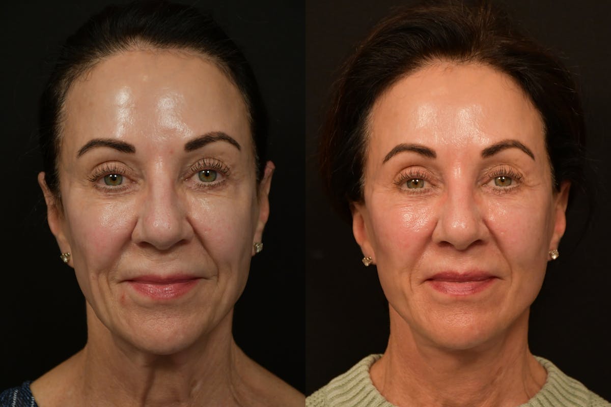 Lip Lift Before & After Gallery - Patient 834185 - Image 1