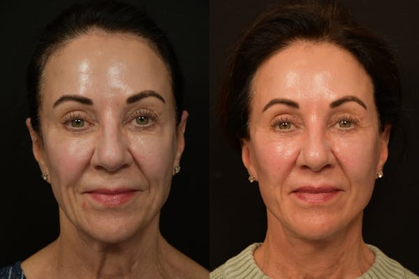 Lip Lift Before & After Gallery - Patient 834185 - Image 1
