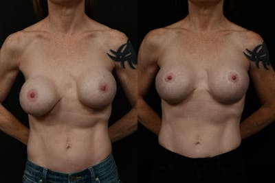 Breast Revision Before & After Gallery - Patient 242255 - Image 1