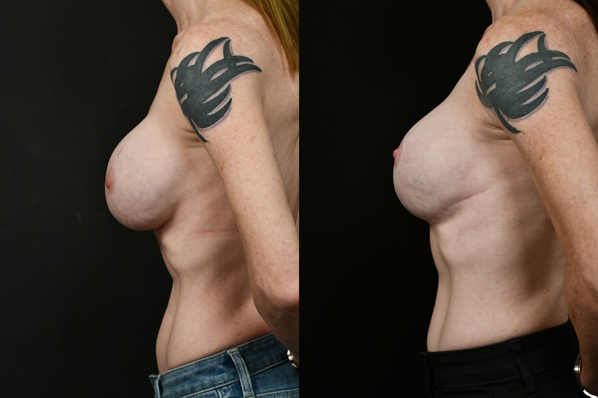 Breast Augmentation Before & After Gallery - Patient 136099 - Image 3