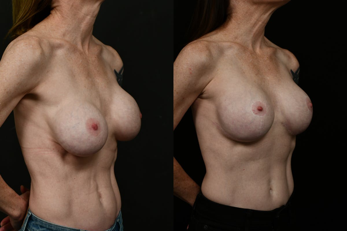 Breast Augmentation Before & After Gallery - Patient 136099 - Image 4