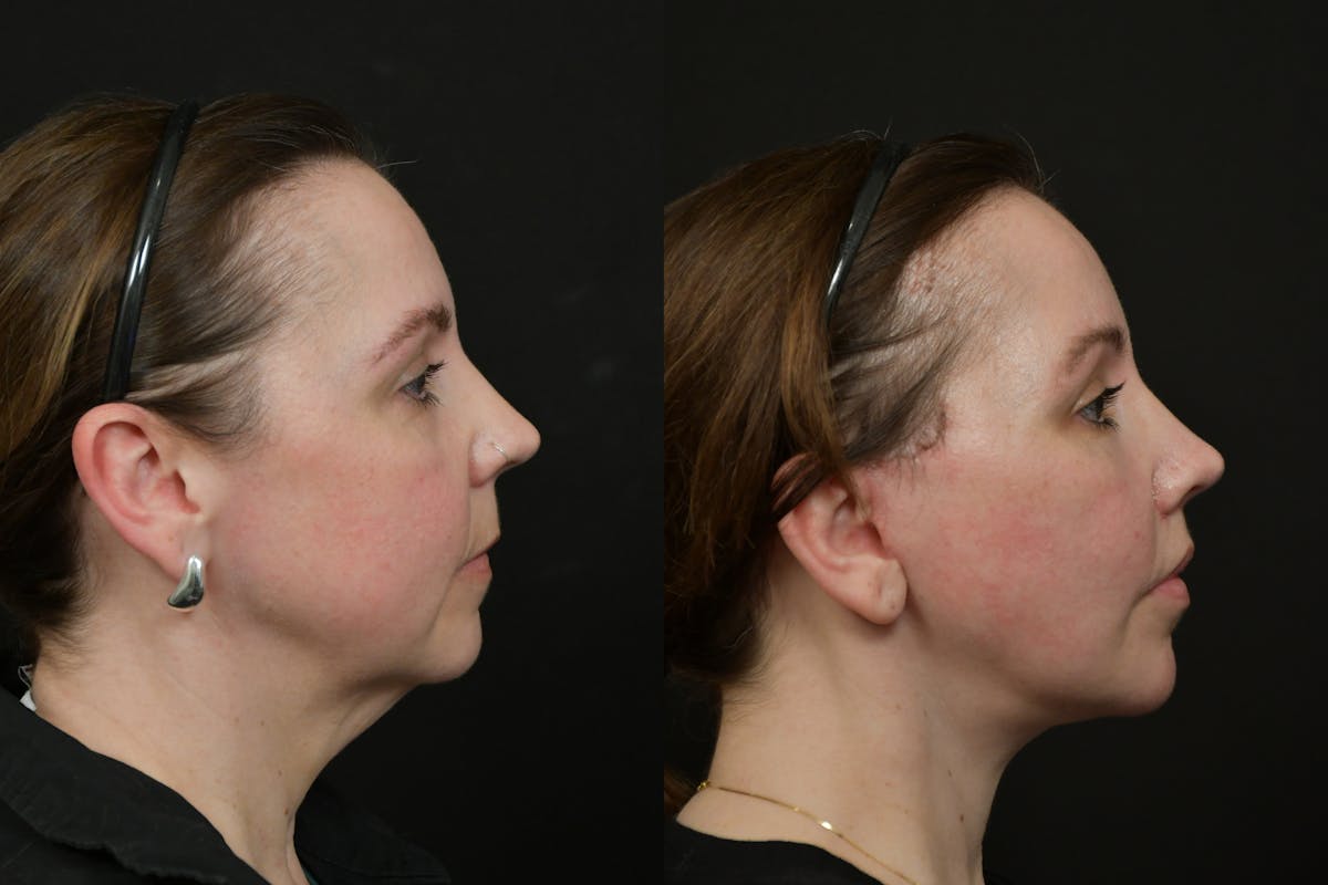 Lip Lift Before & After Gallery - Patient 475169 - Image 3