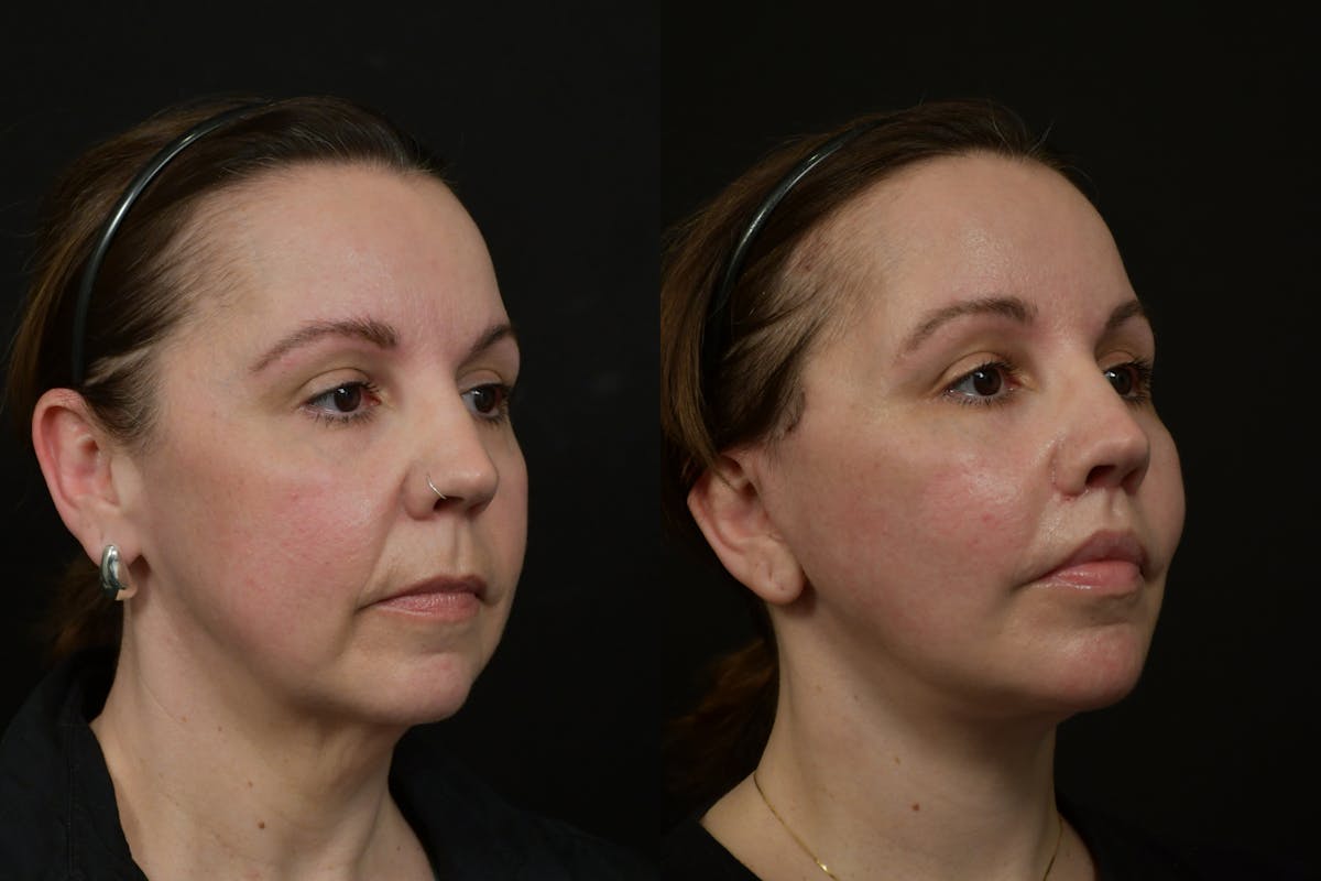 Lip Lift Before & After Gallery - Patient 475169 - Image 2