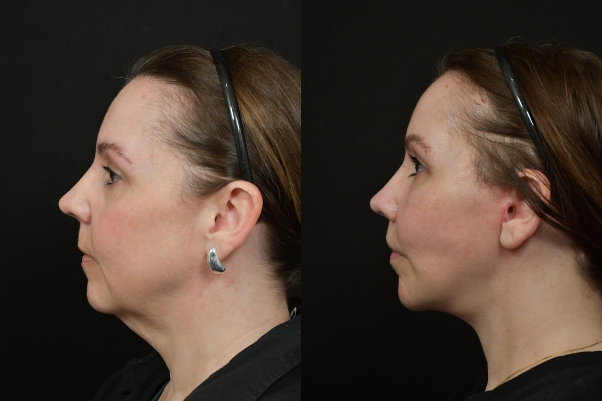 Lip Lift Before & After Gallery - Patient 475169 - Image 5