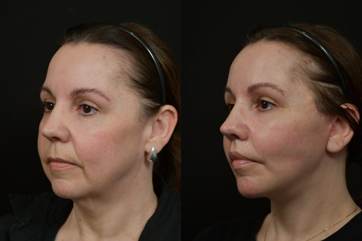 Lip Lift Before & After Gallery - Patient 475169 - Image 4