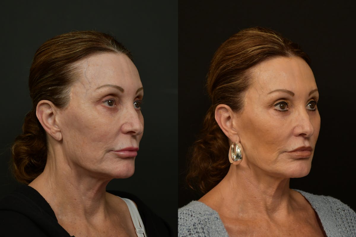 Lip Lift Before & After Gallery - Patient 212644 - Image 2