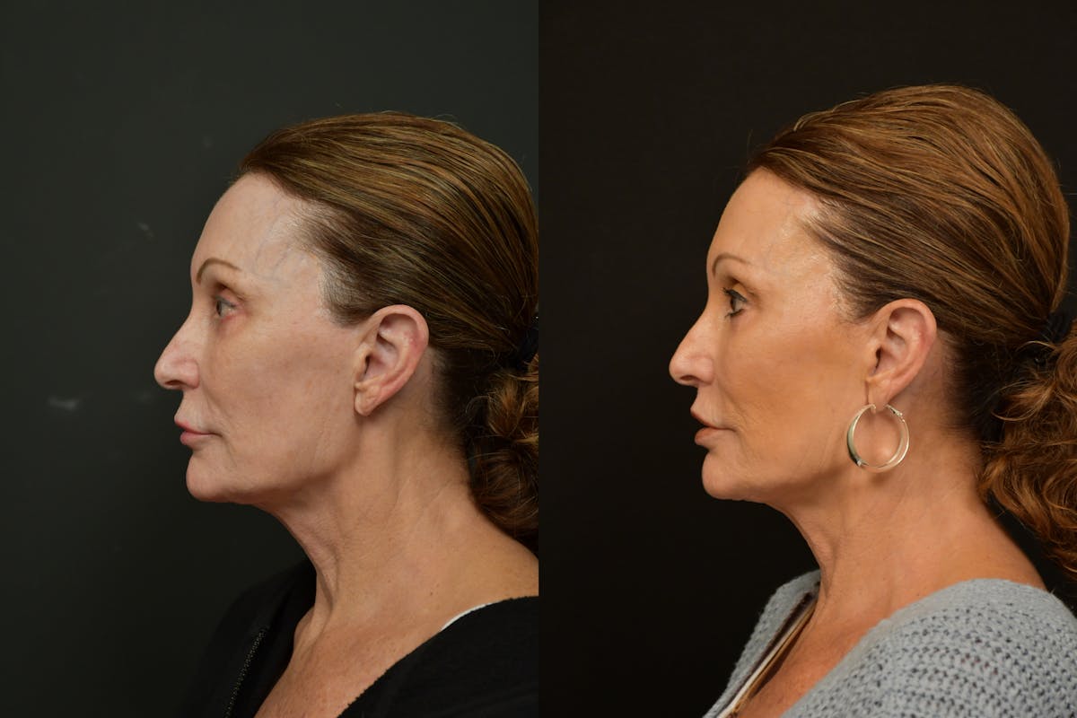 Lip Lift Before & After Gallery - Patient 212644 - Image 5