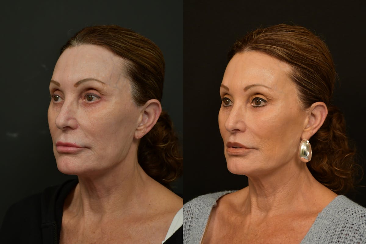 Lip Lift Before & After Gallery - Patient 212644 - Image 4