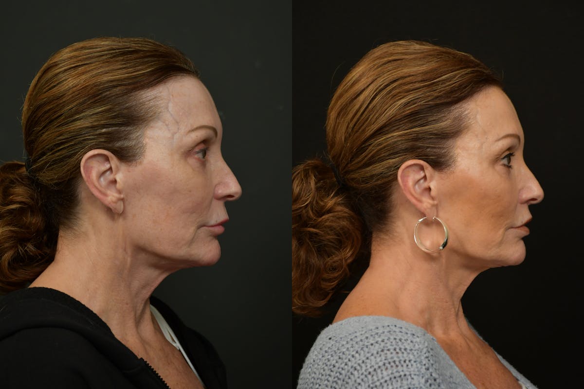 Lip Lift Before & After Gallery - Patient 212644 - Image 3