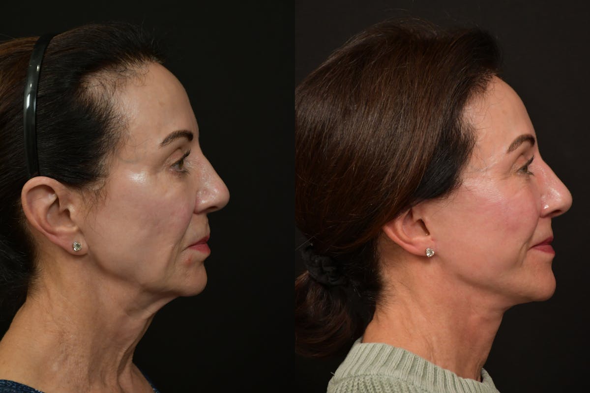 Lip Lift Before & After Gallery - Patient 834185 - Image 3