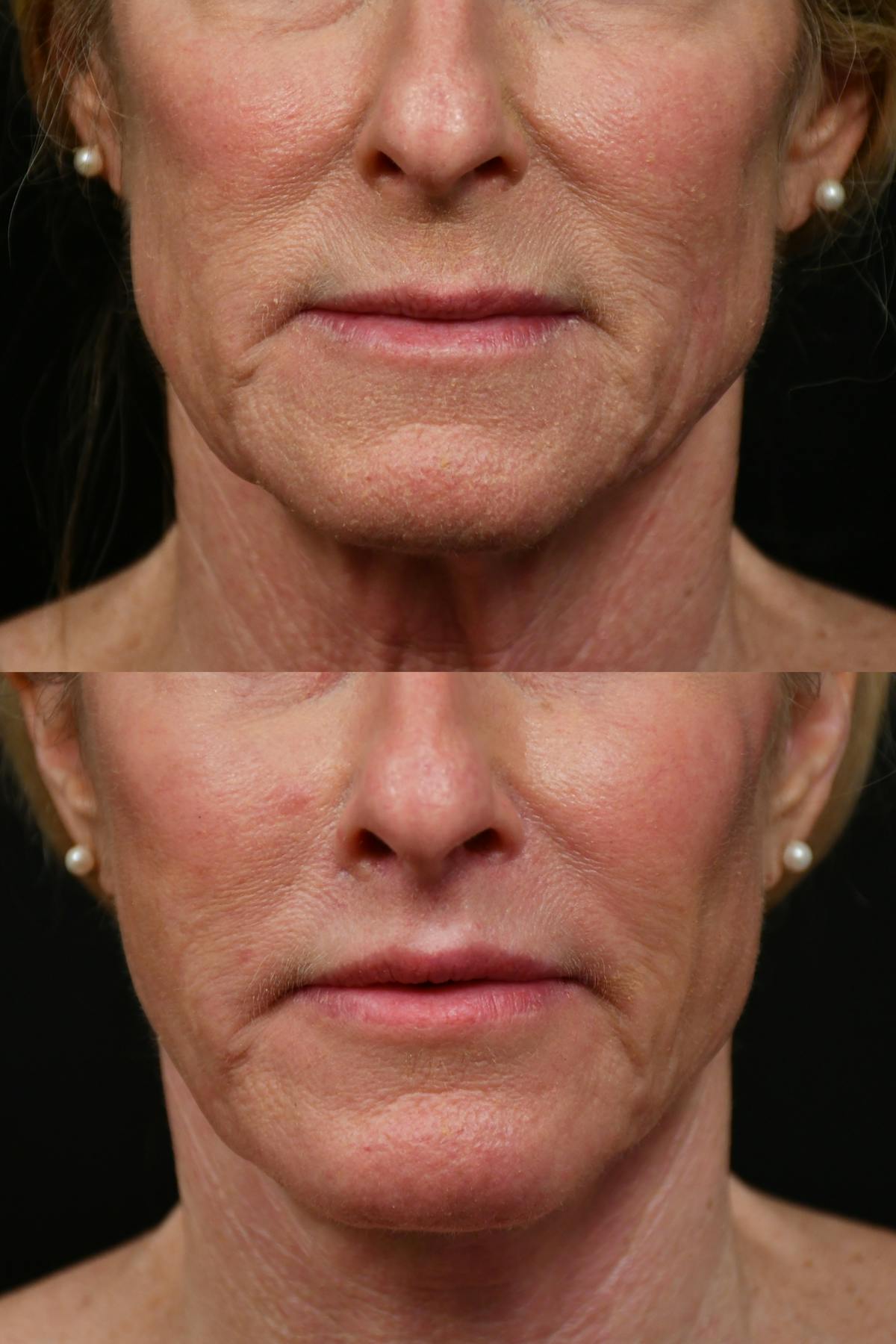 Lip Lift Before & After Gallery - Patient 170755 - Image 10