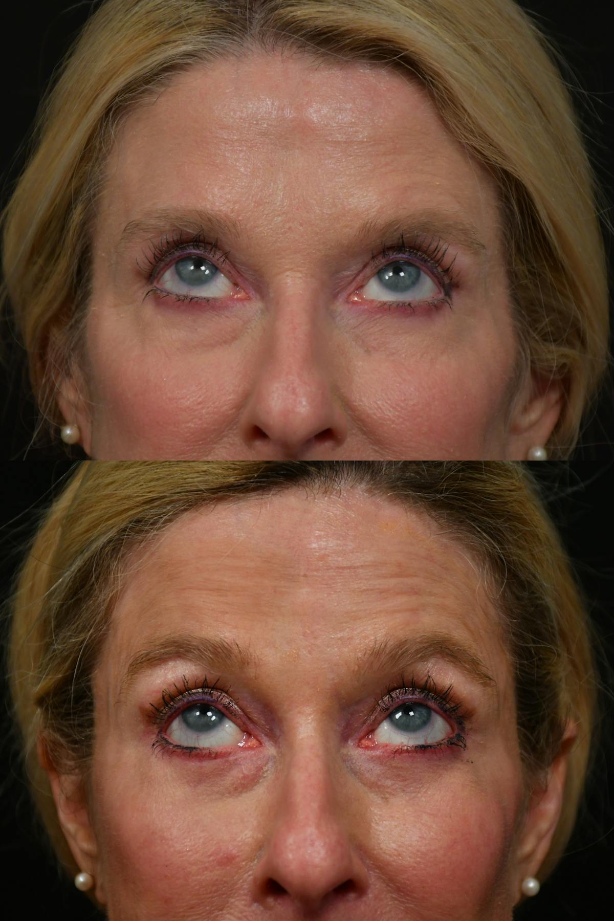 Lip Lift Before & After Gallery - Patient 170755 - Image 8